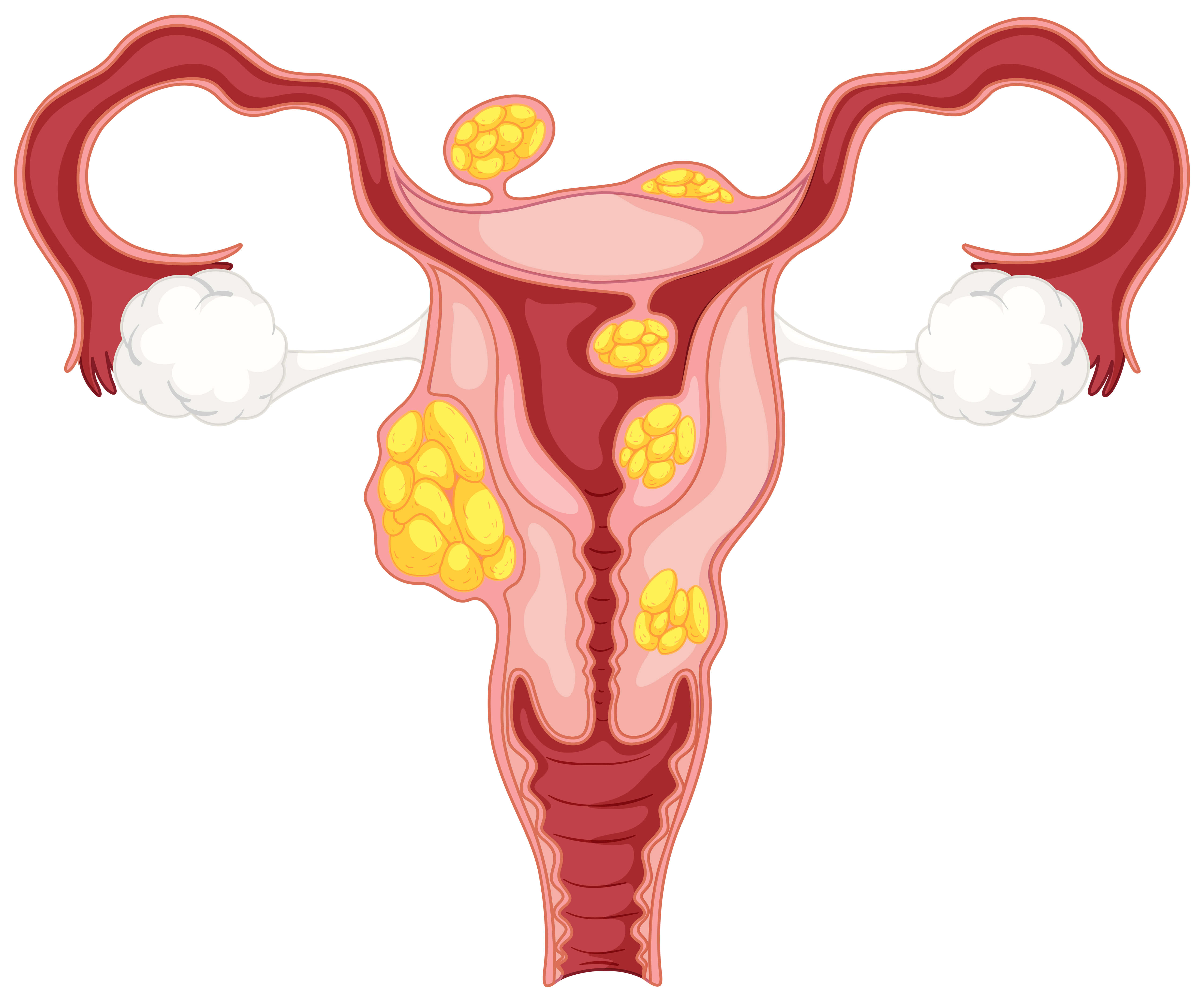 Conheça Os Diferentes Tipos De Mioma Uterino Bedmed