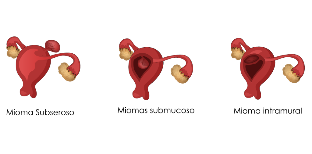 Como é feito o diagnóstico do mioma uterino BedMed