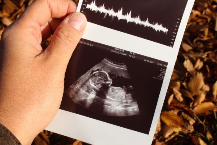 Mão segurando ultrassom de bebê.