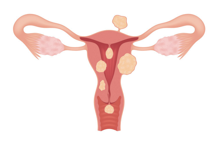 Menstruação com coágulos na endometriose - BedMed