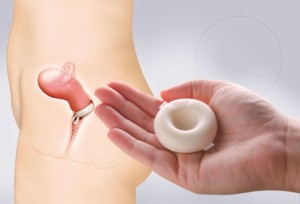 esponja vaginal