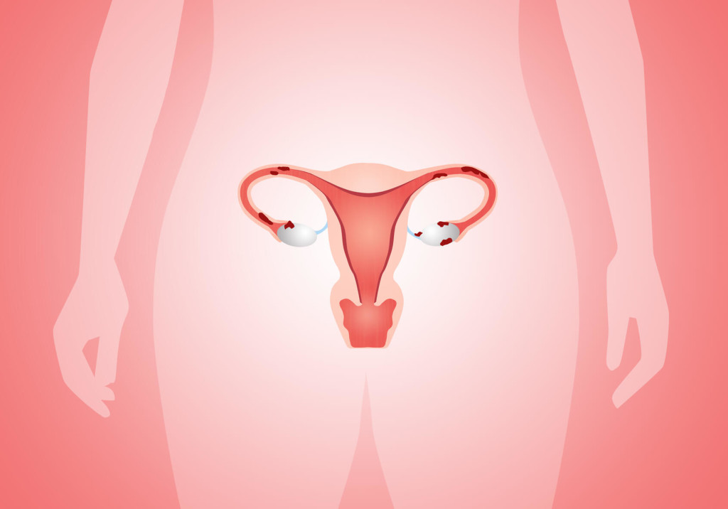 O que é endometriose profunda?
