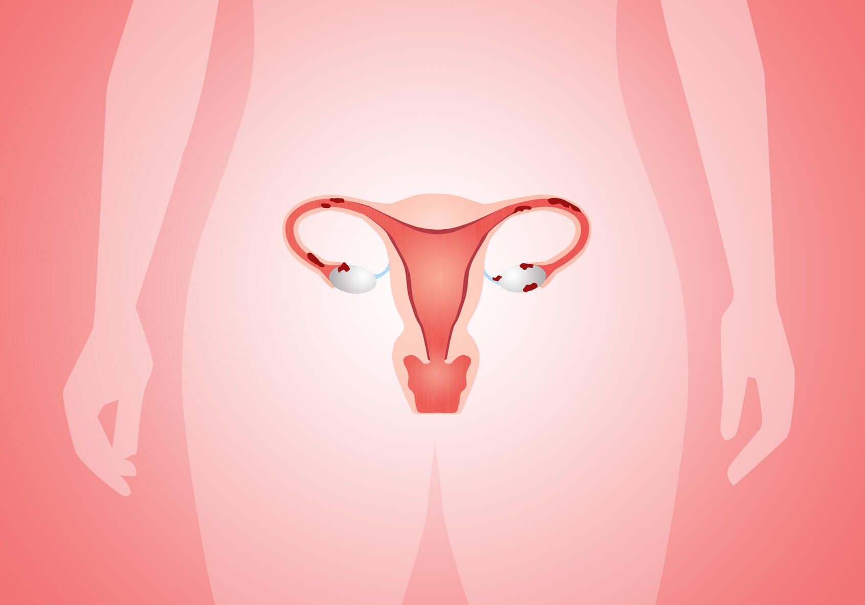 Endometriose profunda