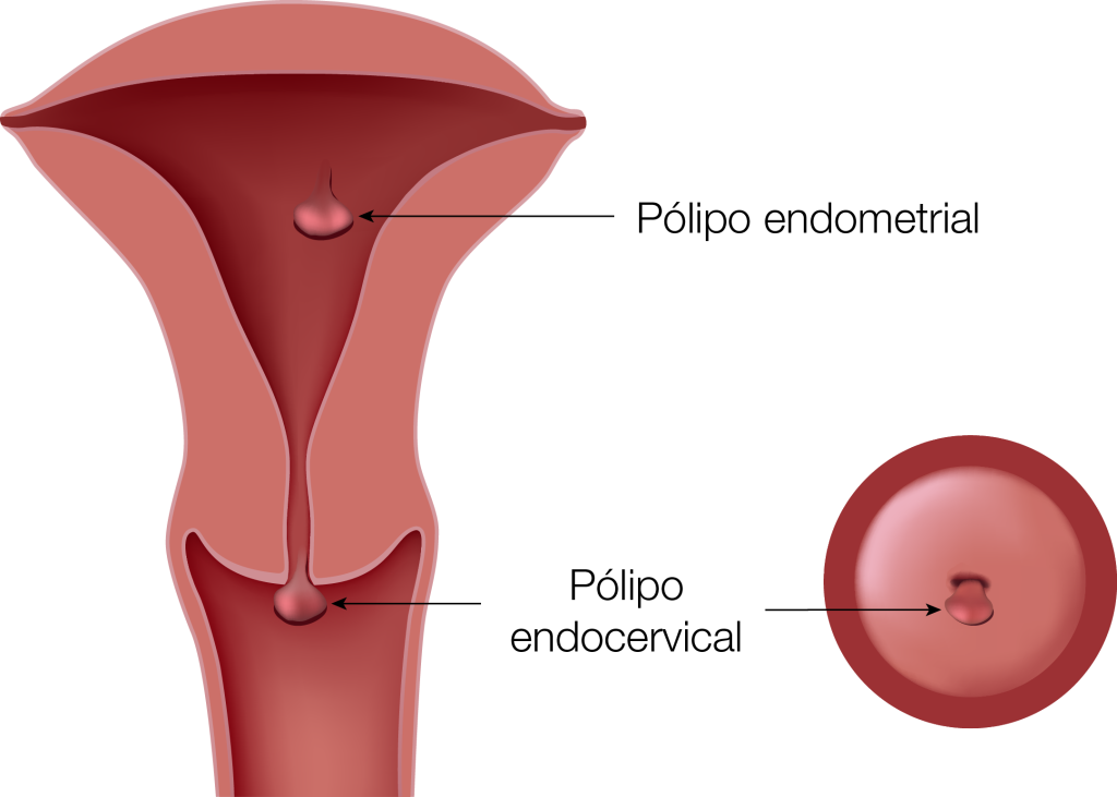 Pólipo uterino