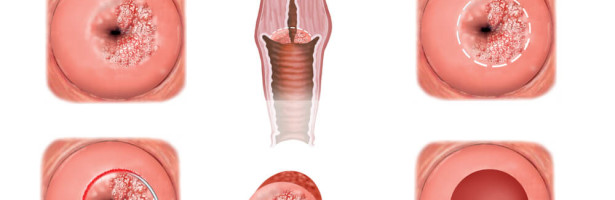 O que é displasia cervical?