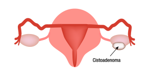 Cistoadenoma