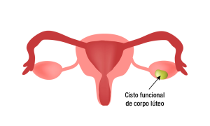 Cisto funcional de corpo lúteo