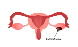 endometrioma