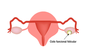 cisto funcional folicular