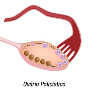 Ovário Policístico