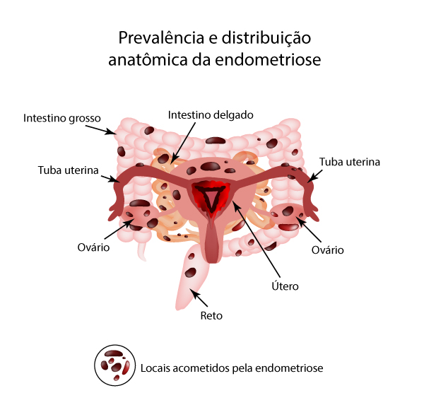 Quando procurar um Especialista em Endometriose? - BedMed