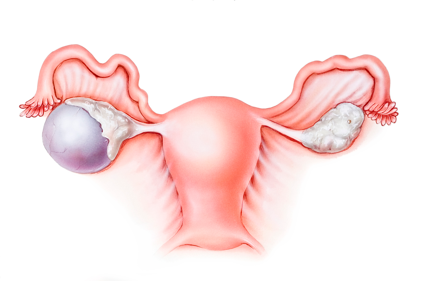 Integra Cirurgia - A remoção de um ou dos dois ovários, chama-se