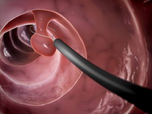 Quais são os principais sintomas dos pólipos uterinos?