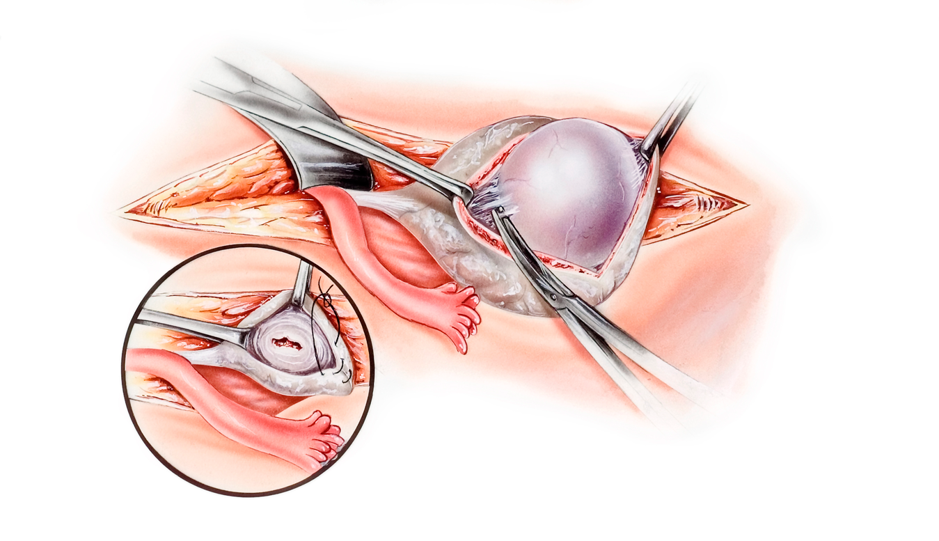 Retirada do Ovário > Cirurgia e Recuperação da Ooforoplastia