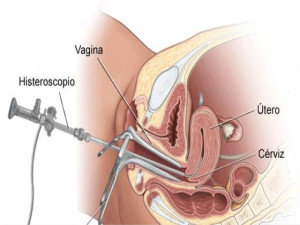 o-que-e-histeroscopia-diagnostica