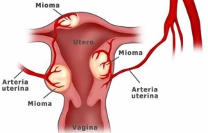 mioma