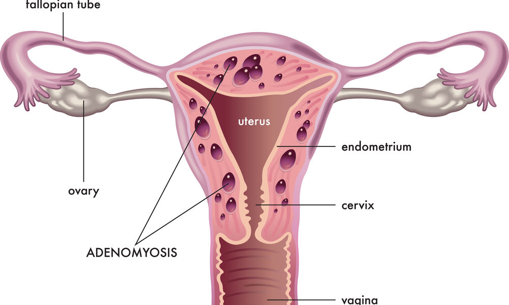 Adenomiose no útero