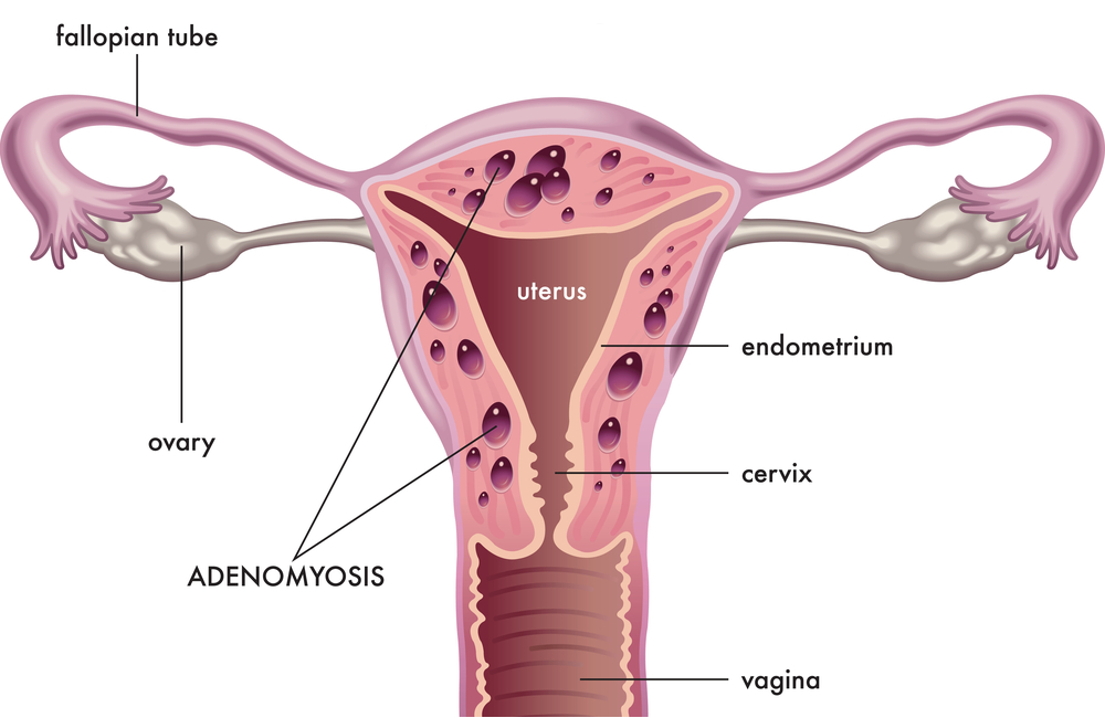 Adenomiose Causas Sintomas E Tratamentos Bedmed