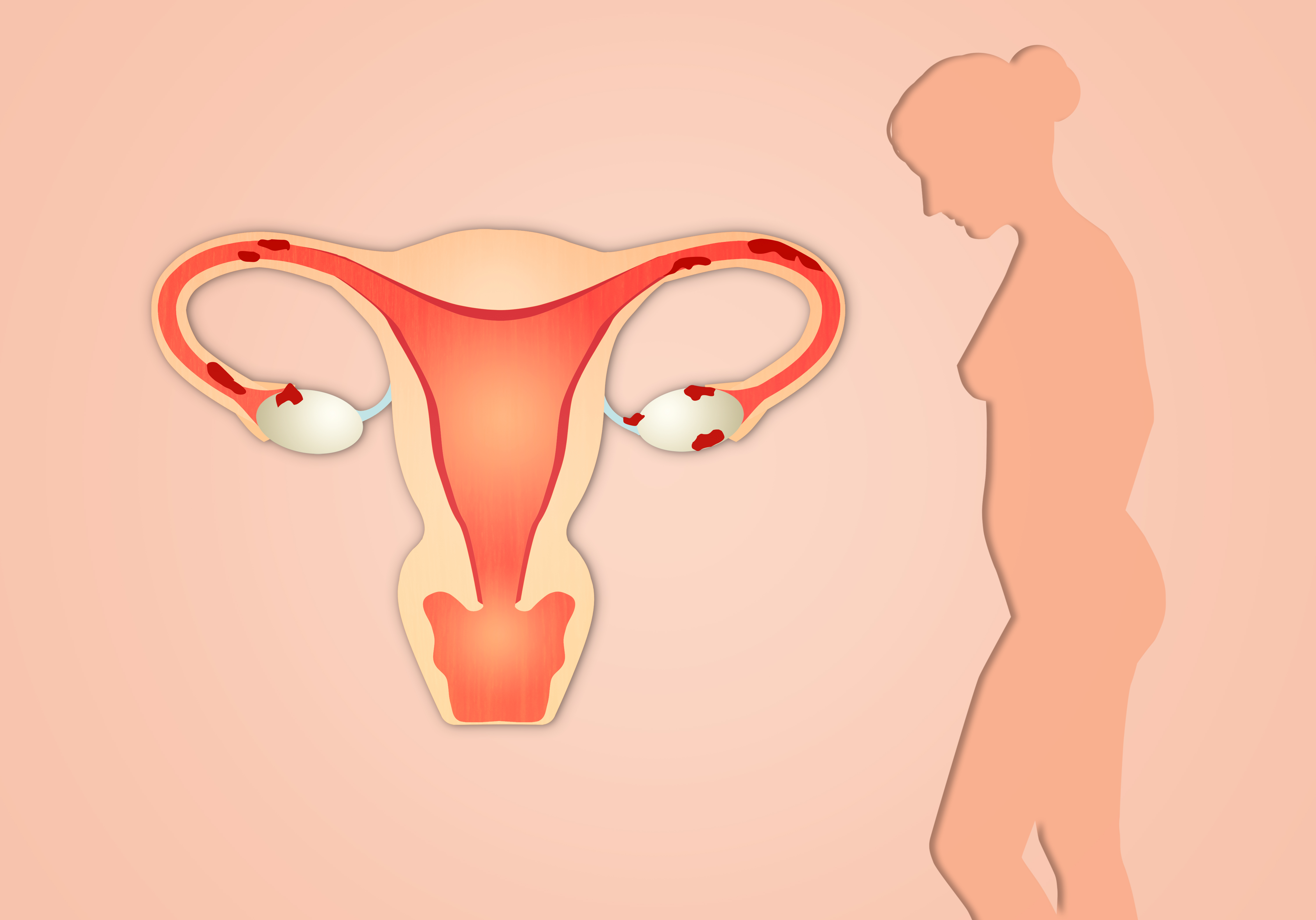 Os coágulos presentes no seu fluxo MENSTRUAL geralmente são