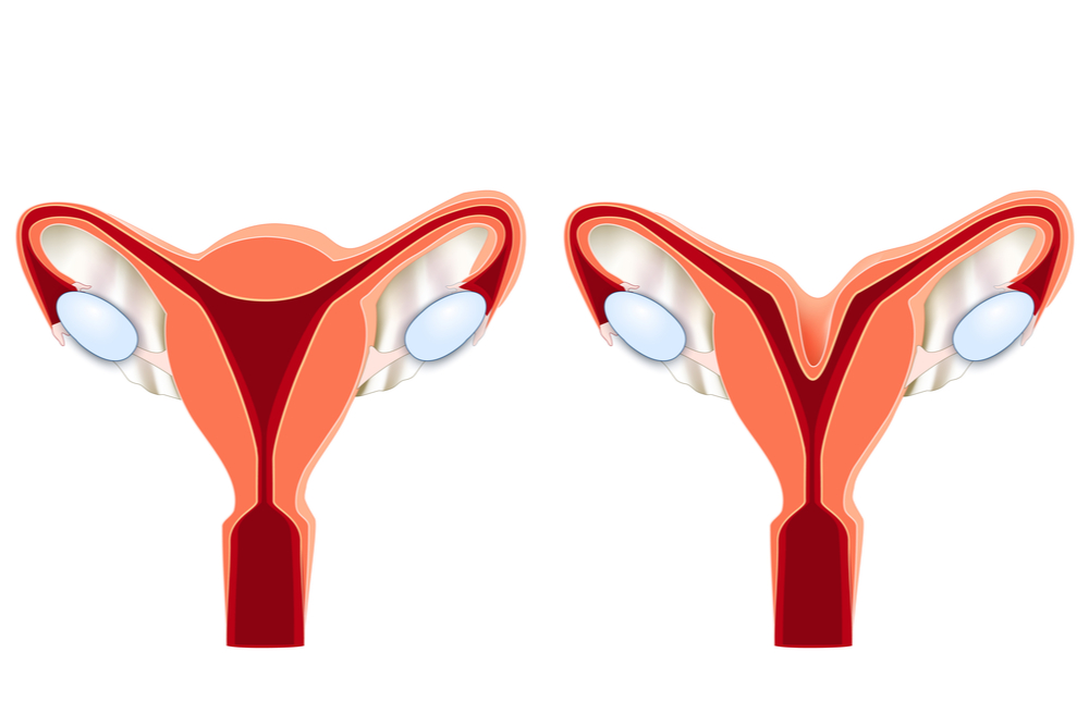 Do lado esquedo, um útero comum. Do lado direito, um útero bicorno.