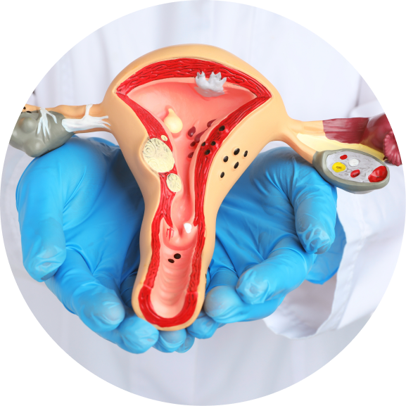 Endometriose e Miomas