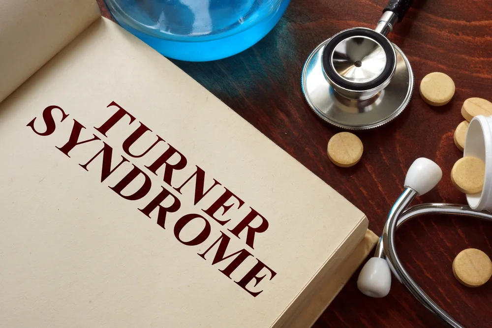 Guia completo sobre a síndrome de Turner - BedMed