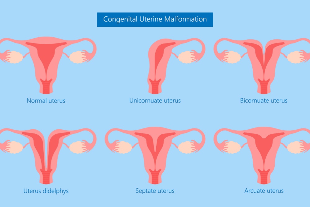 Imagem ilustrativa com as diferentes malformações uterinas.