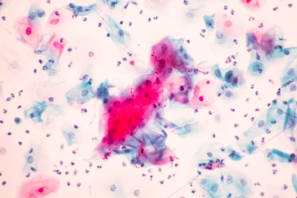 Imagem de candidíase observada ao microscópio ilustrando se a candidíase pode causar infertilidade.