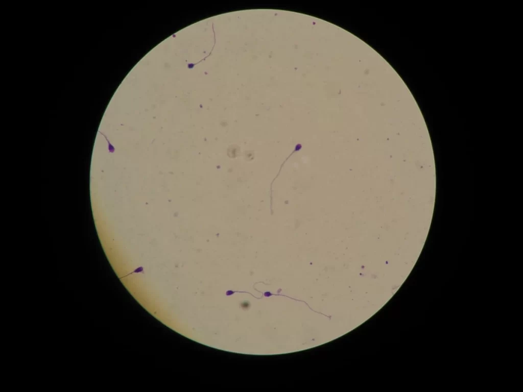 Foto de espermatozoides no microscópio ilustrando a análise da morfologia de Kruger.