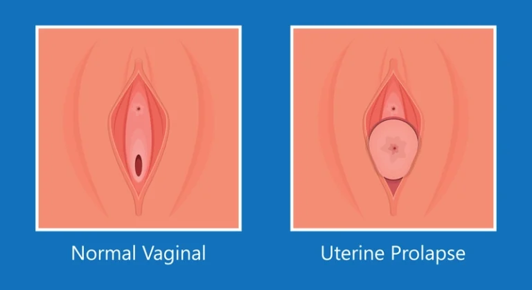 Prolapso uterino: o que é e o que você precisa saber antes de engravidar