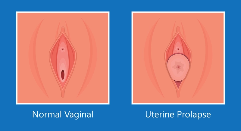 Imagem ilustrando vaginas normal e vagina com prolapso uterino